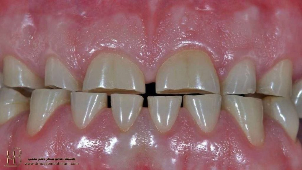 درمان سایش دندان و عوامل ایجاد آن