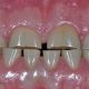 درمان سایش دندان و عوامل ایجاد آن