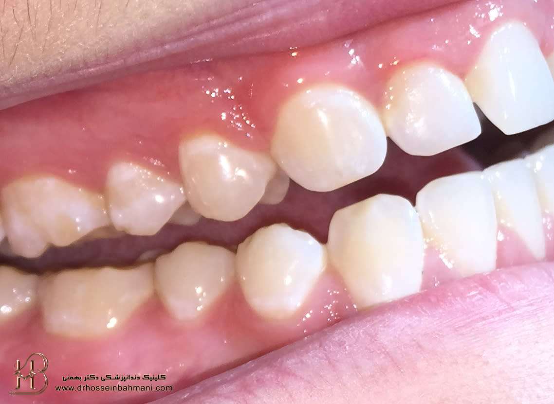 درمان سایش دندان