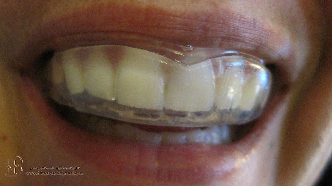 انواع محافظ‌های دهانی