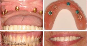 ایمپلنت کل دندانها به چه روش؟