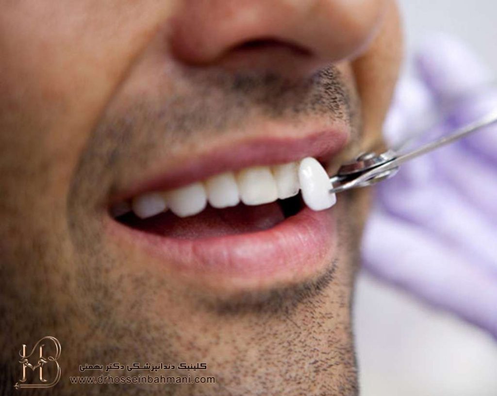 علت و درمان تیر کشیدن دندان روکش شده