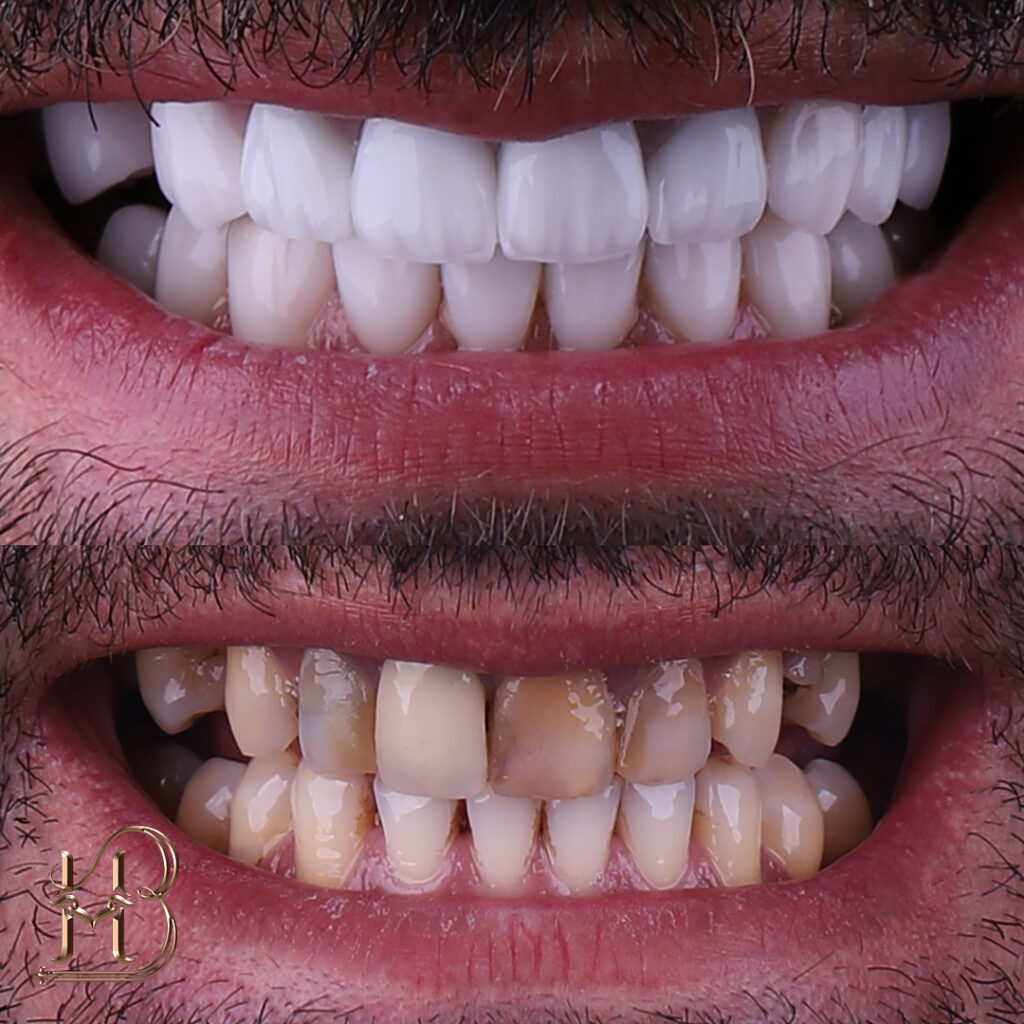 لمینت دندان چیست و چگونه انجام می‌شود؟