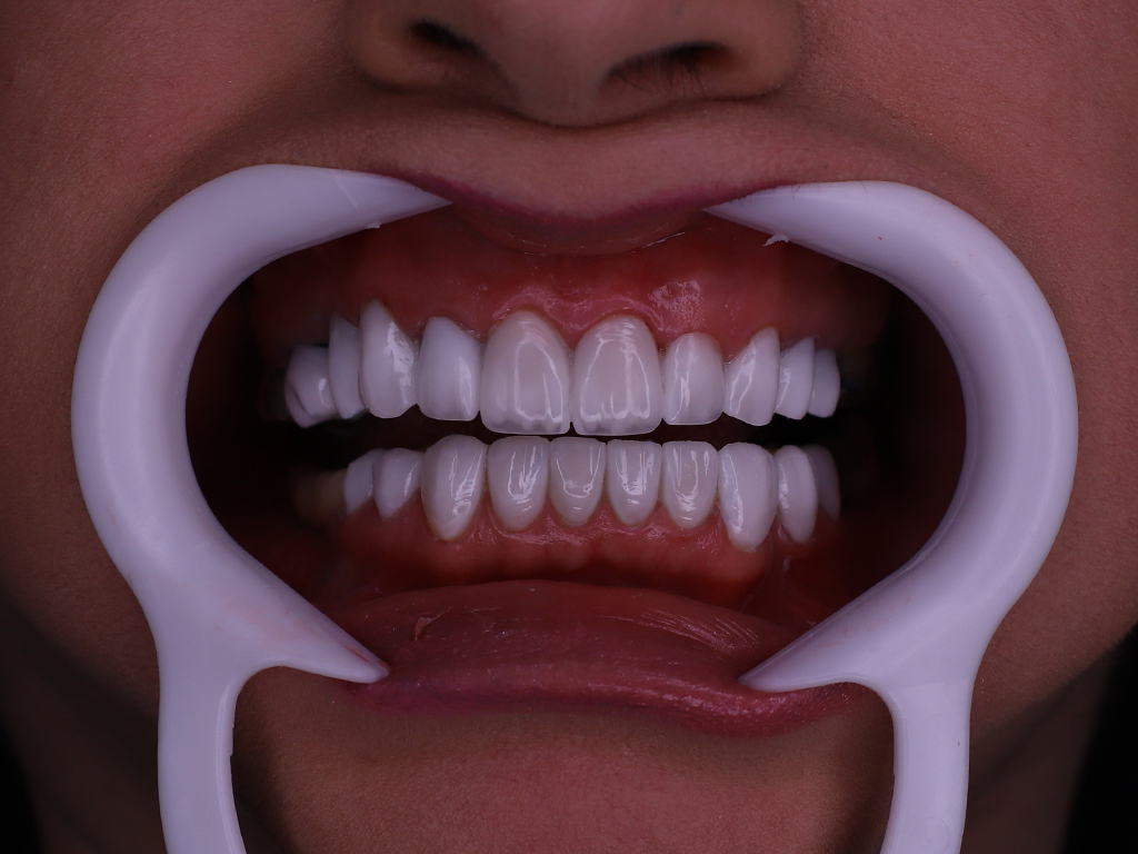 لمینت دندان برای چه کسانی مناسب می‌باشد؟