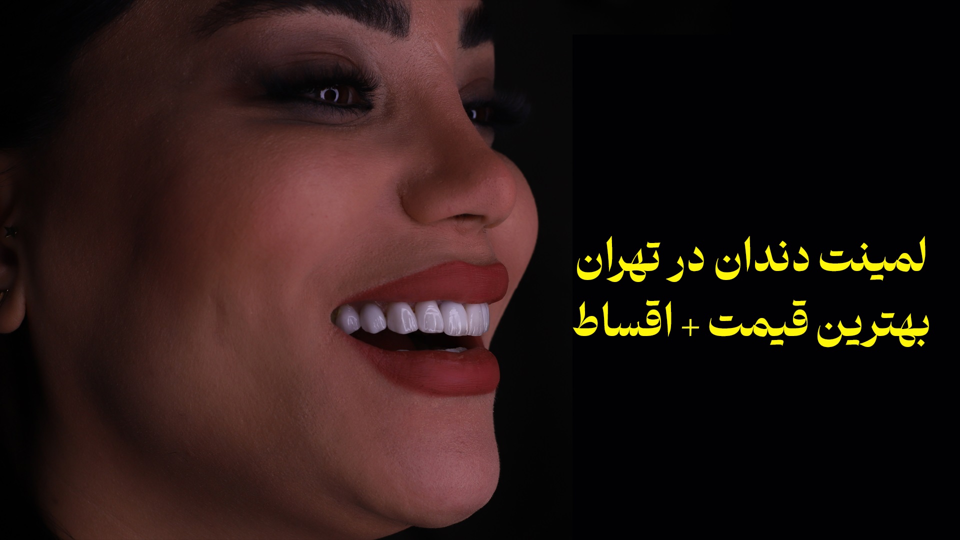 لمینت دندان در تهران