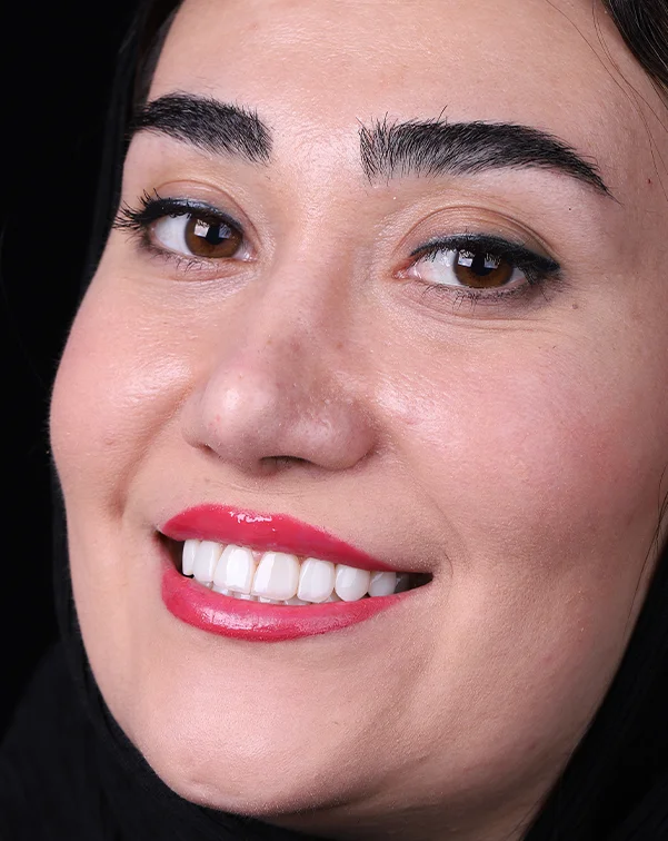کامپوزیت دندان