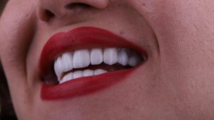لمینت دندان برای چه سنی مناسب است