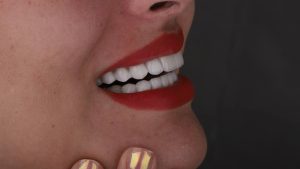 ترمیم لمینت دندان
